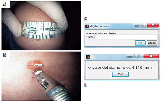 A. Lesi&oacute;n de la piel con tama&ntilde;o conocido (lunar). B. Medida en p&iacute;xeles con la herramienta &ldquo;imdistline&rdquo;. C. Ventana para ingresar el valor en p&iacute;xeles. D. Ventana de resultado del di&aacute;metro del objeto en mil&iacute;metros.