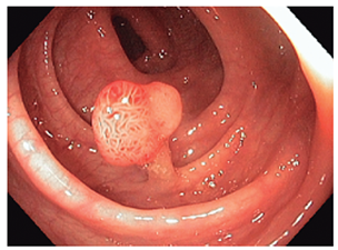 P&oacute;lipo del colon que ser&aacute; sometido al algoritmo. Fotograf&iacute;a (JGP) tomada con el colonoscopio, en una colonoscopia de rutina.