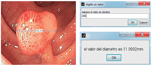P&oacute;lipo sometido al algoritmo