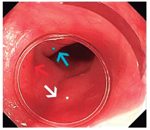 Reparos anat&oacute;micos: arco a&oacute;rtico (flecha y punto rojos), bronquio fuente izquierdo (flecha y punto azules) y silueta de la columna vertebral (flecha y punto blancos) 6.