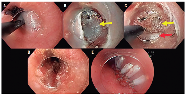 Pasos del POEM. A. P&aacute;pula. B. Mucosotom&iacute;a (flecha amarilla: espacio submucoso). C. T&uacute;nel submucoso (flecha amarilla: espacio submucoso; flecha roja: capa muscular circular). D. Miotom&iacute;a. E. Cierre de mucosotom&iacute;a.