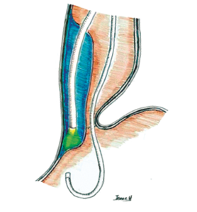 T&eacute;cnica de doble endoscopio, se observa con el endoscopio ubicado en c&aacute;mara g&aacute;strica; en retroflexi&oacute;n, la transiluminaci&oacute;n del endoscopio que realiza el t&uacute;nel submucoso y la miotom&iacute;a 23.