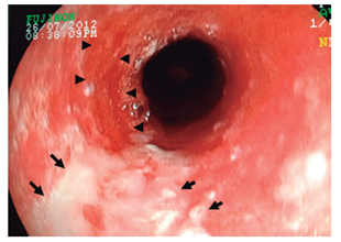 Fragmentos de mucosa esfacelada en el tercio medio proximal del es&oacute;fago (flechas) y en las zonas extensas descubiertas cruentas (cabeza de flechas) (caso 1).