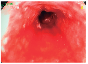 Esfacelo difuso de la mucosa del tercio medio del es&oacute;fago, con sangrado en capa (caso 1).
