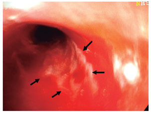 Fragmentos de mucosa esof&aacute;gica esfacelada en el tercio medio (flechas) y sangrado en capa (caso 1).