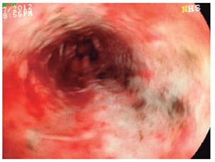 Esfacelo difuso de la mucosa esof&aacute;gica con ulceraci&oacute;n extensa, focos de necrosis en el tercio distal y zonas de sangrado en capa (caso 1).