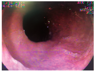 Es&oacute;fago cervical normal (caso 3).