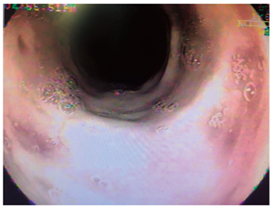 Ulceraci&oacute;n esof&aacute;gica proximal circunferencial recubierta por fibrina (caso 3).