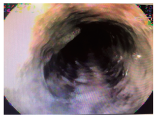 Es&oacute;fago negro y gris&aacute;ceo distal (caso 3).