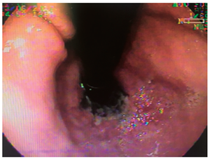 Uni&oacute;n cardioesof&aacute;gica en retrovisi&oacute;n, con cardias respetado (caso 3).