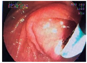 Esfinterotom&iacute;a peque&ntilde;a para drenaje para extracci&oacute;n de c&aacute;lculos (caso 3).