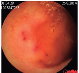 Erosiones a nivel yeyunal.