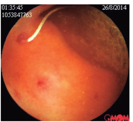 Parásitos intestinales blanquecinos adheridos a la pared intestinal.