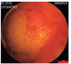 Gran úlcera cubierta de fibrina. Múltiples parásitos adheridos a la pared intestinal.