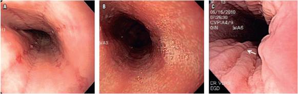 Esofagoscopia. A. surcos longitudinales. B. Exudados blanquecinos. C. Erosiones.