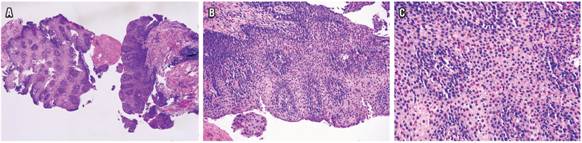 A. H & E 4 X, muestra marcada acantosis, hiperplasia de c&eacute;lulas basales y papilomatosis. B. H & E 20 X, muestra aumento de la celularidad intraepitelial, predominantemente de eosin&oacute;filos. C. H & E 40 X, muestra infiltrado de eosin&oacute;filos con presencia de m&aacute;s de 80 por CAP.
