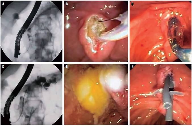 Manejo de c&aacute;lculos en el CPP en paciente con PC. A. La pancreatograf&iacute;a muestra varios c&aacute;lculos en la cabeza. B. Esfinterotom&iacute;a del pancre&aacute;tico. C. Dilataci&oacute;n con bal&oacute;n de la esfinterotom&iacute;a. D. Paso de bal&oacute;n de extracci&oacute;n. E. C&aacute;lculos pancre&aacute;ticos extra&iacute;dos. F. Paso de 2 stents pancre&aacute;ticos de 7 Fr por 10 cm.