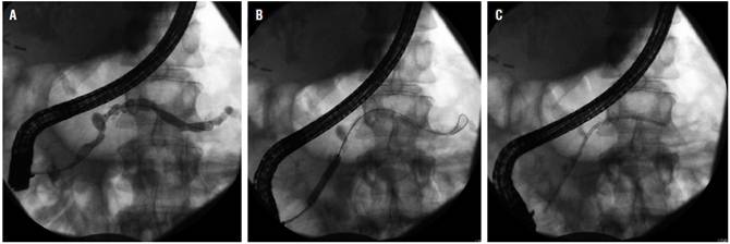 Manejo de estenosis benigna con dilataci&oacute;n y stent en un paciente con PC. A. Estenosis en la cabeza del p&aacute;ncreas. B. Dilataci&oacute;n con bal&oacute;n de la estenosis. C. Paso del stent pancre&aacute;tico. 