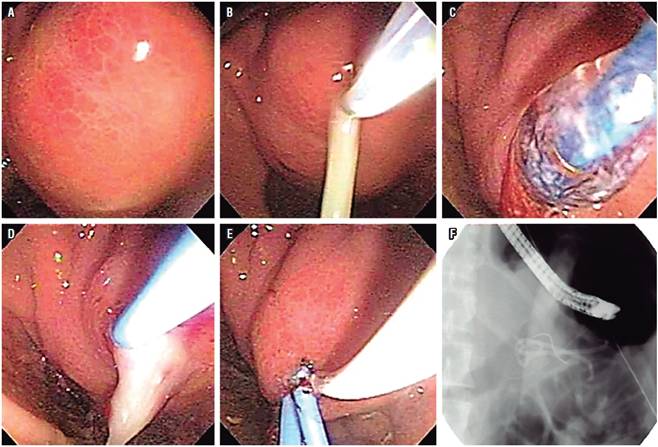 Drenaje endosc&oacute;pico de PP en PC. A. PP que abomba en el antro g&aacute;strico. B. Punci&oacute;n con aguja de precorte con salida de pus. C. Dilataci&oacute;n transmural con bal&oacute;n hasta 10 mm. D. Paso de primer cat&eacute;ter cola de cerdo 7 Fr. E. Paso del segundo cat&eacute;ter cola de cerdo. F. Aspecto fluorosc&oacute;pico del doble drenaje.