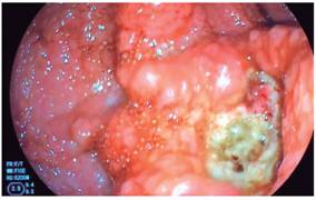 C&aacute;ncer g&aacute;strico.