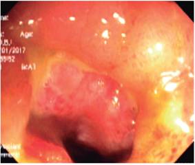 Severos cambios inflamatorios dados por edema, eritema, úlcera circunferencial en la válvula ileocecal e íleon distal.