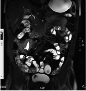 Enterorresonancia en la que se evidencia marcado engrosamiento en el íleon distal con áreas ulceradas y hallazgos de actividad de Crohn con compromiso inflamatorio-fibrótico.