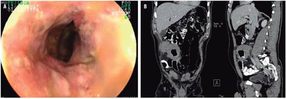 A. Mayor engrosamiento, además de severos cambios inflamatorios con ulceración circunferencial en la válvula ileocecal e íleon distal (4 meses después). B. TAC de abdomen contrastado, corte coronal en el que se identifica una lesión de aspecto tumoral en el íleon distal.