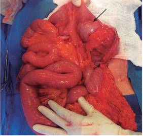 Foto durante la laparotomía en la que se identifica una lesión de aspecto tumoral. Se realizó ilectomía y hemicolectomía derecha.