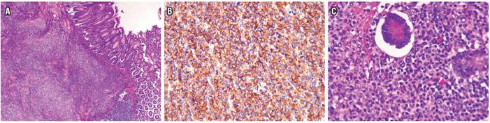 A. Foto en 4x. Neoplasia con patrón difuso que invade todo el espesor de la pared, incluida la mucosa, con ulceración focal. B. Inmunohistoquímica CD20, que muestra positividad fuerte y difusa para CD20 en la membrana de los linfocitos tumorales. C. Foto en 40x, mucosa a mayor aumento en la que se aprecian mú́ltiples linfocitos neoplá́sicos de tamaños grandes y núcleos vesiculosos, los cuales son discohesivos y presentan abundantes figuras mitó́ticas, sin presencia de lesió́n linfoepitelial.