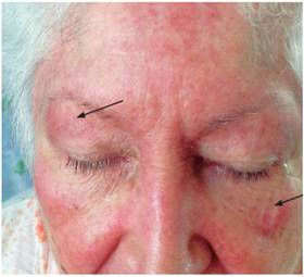 Eritema en heliotropo. Obs&eacute;rvese la tonalidad viol&aacute;cea de las lesiones y su distribuci&oacute;n alrededor de los ojos y los p&aacute;rpados de forma bilateral y sim&eacute;trica acompa&ntilde;adas de un cierto grado de edema.