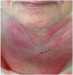 Eritema en la cara anterior del cuello y la &laquo;V&raquo; del escote.