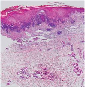 Corte histol&oacute;gico panor&aacute;mico de piel. Obs&eacute;rvese el infiltrado inflamatorio perivascular de la dermis papilar y de la dermis profunda (H/E 20x).