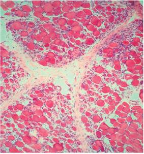 Campo histol&oacute;gico del m&uacute;sculo deltoides que muestra inflamaci&oacute;n perimicial y endomicial de predominio linfoc&iacute;tico con necrosis y atrofia de fibras (H/E 40x).