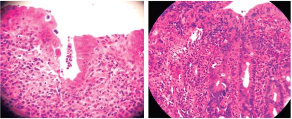 A y B. Microfotograf&iacute;a histol&oacute;gica de la biopsia del colon con presencia de inflamaci&oacute;n cr&oacute;nica severa de toda la mucosa y en la que se aprecia criptitis t&iacute;pica de la enfermedad (H/ E 40x).