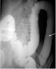 Colon por enema. Obs&eacute;rvese la p&eacute;rdida de las haustras con rigidez de la pared del colon descendente y sigmoide.