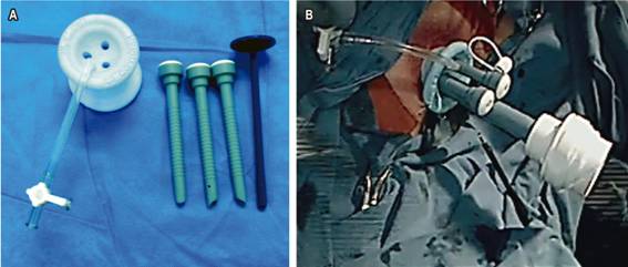 A. SILS™ Port y tres trócares de 5 mm. B. Introducción del dispositivo SILS™ Port.