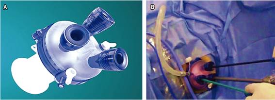 A. GelPOINT® Path, plataforma de acceso transanal. B. Ubicación en el canal anal.