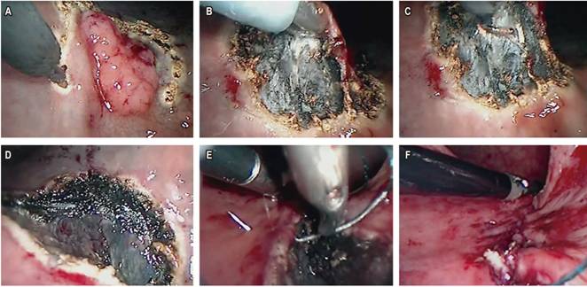 Secuencia de eventos en la marcación y la resección del espesor total de la lesión rectal. A. Marcación de la periferia de la lesión. B. Levantamiento del margen inferior. C. Disección transmural de la lesión. D. Escisión completa de la lesión. E. Sutura de los márgenes de la resección. F. Línea de sutura con el material absorbible.