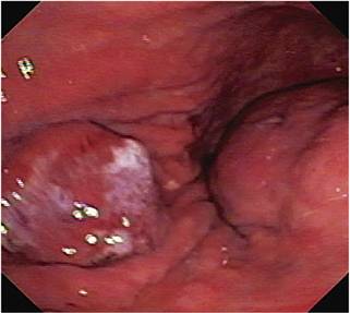 En la imagen se ven las dos lesiones, la de la izquierda corresponde al cáncer gástrico temprano y la de la derecha corresponde al GIST.