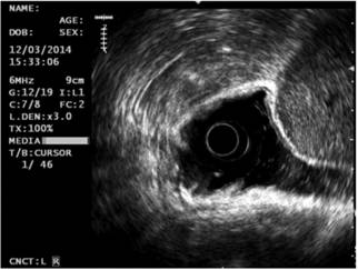 Ultrasonografía endoscópica gástrica. A la izquierda, CG; a la derecha, lesión subepitelial.