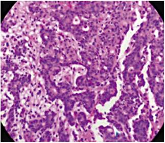 Adenocarcinoma gástrico moderadamente diferenciado.