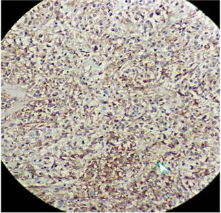 GIST c-kit positivo.