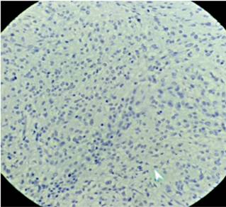 GIST CD 34 (+) S100 (-).
