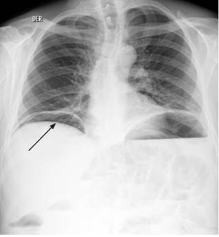 Radiografía de tórax posteroanterior de pie. Se aprecia la imagen del neumoperitoneo bilateral (flecha) con colección subpulmonar basal bilateral con nivel hidroaéreo en la base izquierda acompañado de la elevación de ambos hemidiafragmas y opacidades intersticiales reticulares biliares bilaterales, sin derrames pleurales.