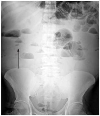 Radiografía simple de abdomen. Se aprecian múltiples niveles hidroaéreos (flecha) que comprometen toda la cavidad abdominal, sobre todo en el mesogastrio y epigastrio, con presencia de aire en la ampolla rectal (obstrucción parcial o fenómeno de íleo).