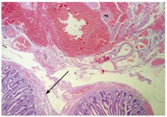 Segmento del yeyuno en el que se observa más evidentemente el edema e inflamación a través de toda la pared (flecha) en presencia de formaciones diverticulares (hematoxilina-eosina. Aumento: 50 X).
