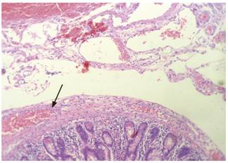 Segmento del intestino delgado en el que se observa un edema de la pared con un infiltrado inflamatorio que va desde la mucosa hasta la serosa; además, se observa un sangrado que se ve está más allá de la serosa (flecha), pero no adherido a ella, que probablemente esté en relación con el sangrado en el peritoneo (hematoxilina-eosina. Aumento: 100 X).