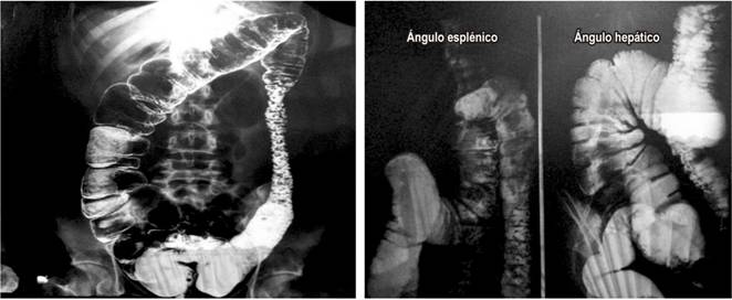 Radiograf&iacute;a abdominal en proyecci&oacute;n anteroposterior, de pie, con uso de enema baritado. Se evidencia engrosamiento de las paredes col&oacute;nicas, dilataciones irregulares del marco col&oacute;nico, aumento y heterogeneidad de secreci&oacute;n en el colon ascendente y en el &aacute;ngulo hep&aacute;tico, as&iacute; como en el colon descendente y sigmoides con im&aacute;genes polipoideas m&uacute;ltiples y signos correlativos con &uacute;lceras en collar.