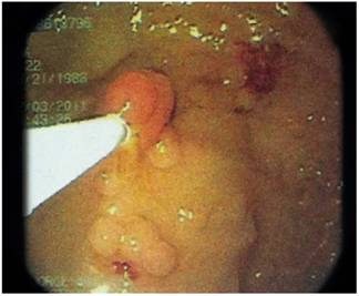 Rectosigmoidoscopia. Se evidencia un p&oacute;lipo pediculado de aspecto tubular.