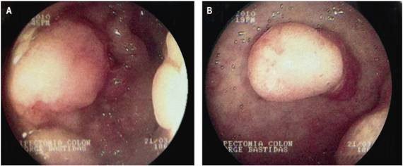 Gastroduodenoscopia. Fondo (A) y cuerpo (B) g&aacute;strico con m&uacute;ltiples p&oacute;lipos s&eacute;siles de di&aacute;metros diversos.